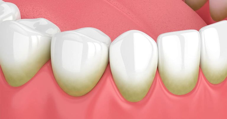 zubnoy-kamen