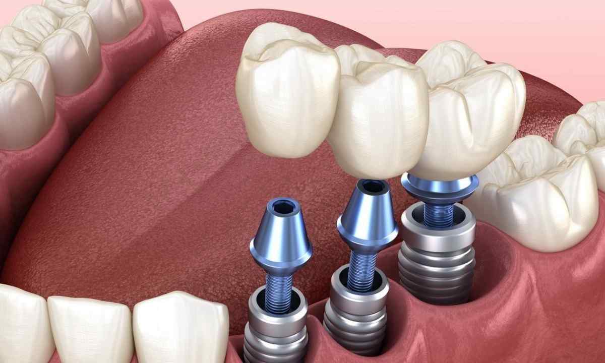 Имплантация зубов в Китае