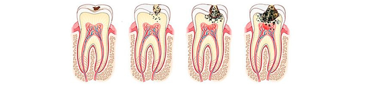 Кариес клиническая картина